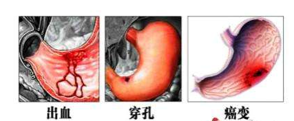 壮男喝酒“喝”出胃穿孔 春节应注意饮食预防消化性溃疡