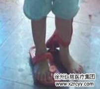 男子因穿拖鞋致骨折 专家提醒 拖鞋也要正确穿