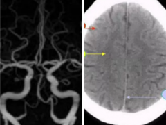 徐医科附医院神经内科冯宇：解读“CT”、“CTA”， 别怪他人以“貌”取人