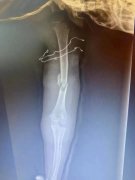 11岁男孩小区玩水摔断手臂 徐矿总医院骨科微创-弹性髓内针固定术治疗