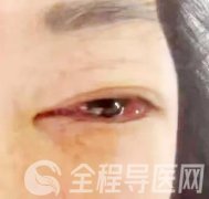徐州市一院眼科联合血管外科成功救治一名罕见颈动脉海绵窦瘘患者