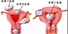 患子宫肌瘤还能怀孕吗？子宫肌瘤一定要切除吗？