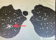 肺炎还是肺癌? 一字之差 徐州市肿瘤医院胸外科侯予龙慧眼识“瘤”