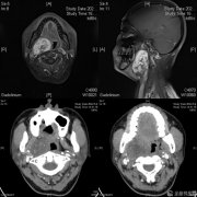 徐医附院口腔颌面外科成功经颈外入路摘除口咽巨大神经鞘瘤